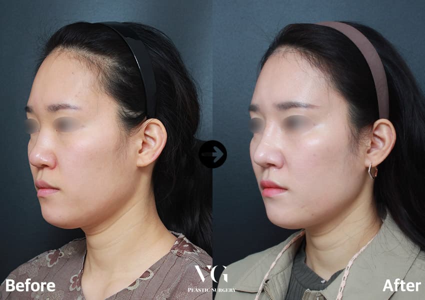 Donor Rib Cartilage + Bulbous Tip Correction + Turbinate Reduction +1