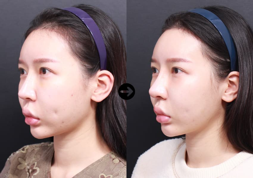 Revision Rhinoplasty + Autologous Rib Cartilage + Alar Base Reduction +3