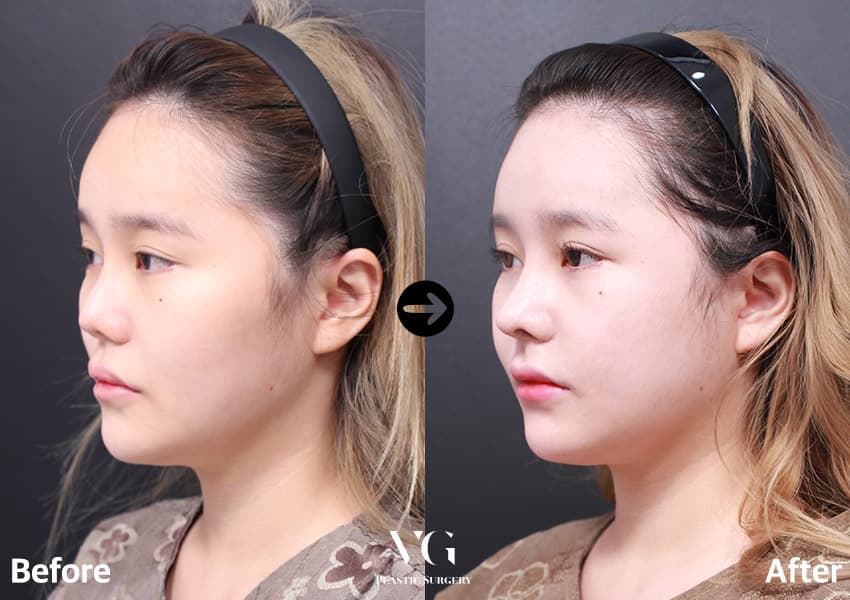 Revision Rhinoplasty + Autologous Rib Cartilage + Turbinate Reduction