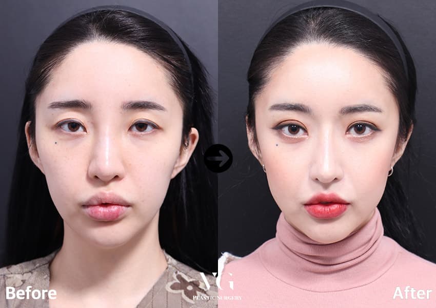 Cheekbone (Zygoma) Reduction + Rhinoplasty + Autologous Rib Cartilage +5