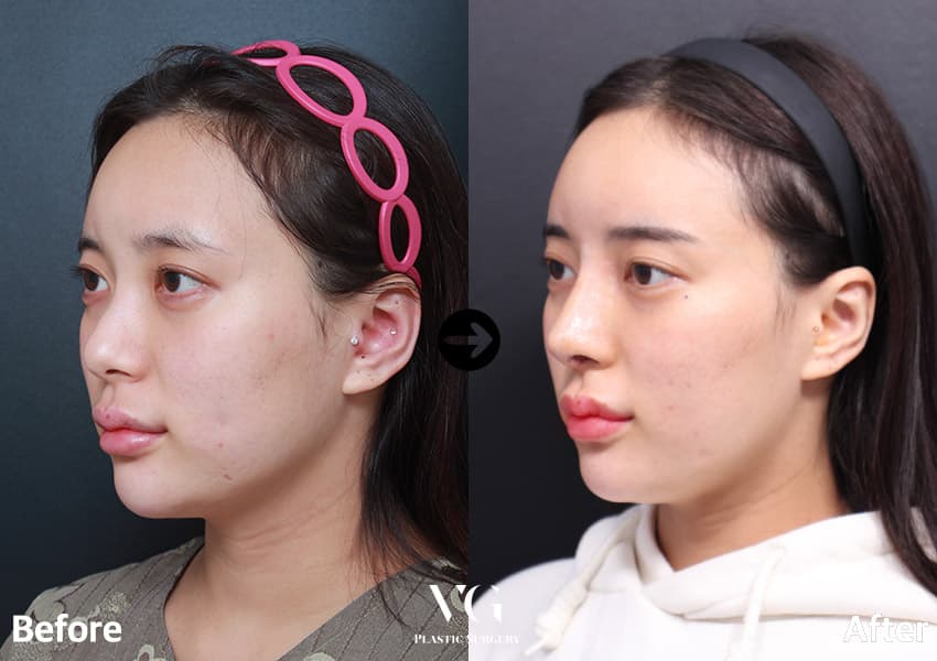 Rhinoplasty + Donor Rib Cartilage