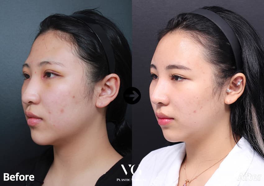 Rhinoplasty + Osteotomy (Bridge Narrowing) + Natural-Adhesion Double Eyelid +1