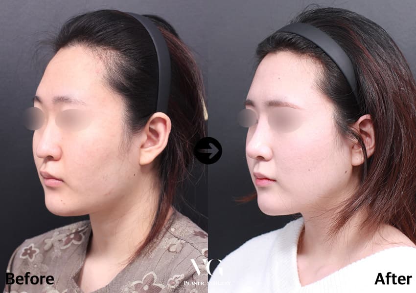 Rhinoplasty + Bulbous Tip Correction + Hump Reduction