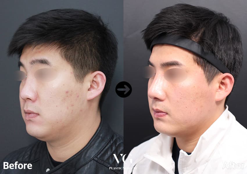 Rhinoplasty + Bulbous Tip Correction