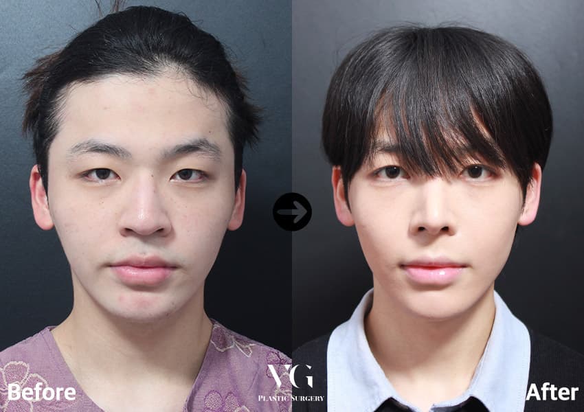Cheekbone (Zygoma) Reduction + Rhinoplasty + Alar Base Reduction +4
