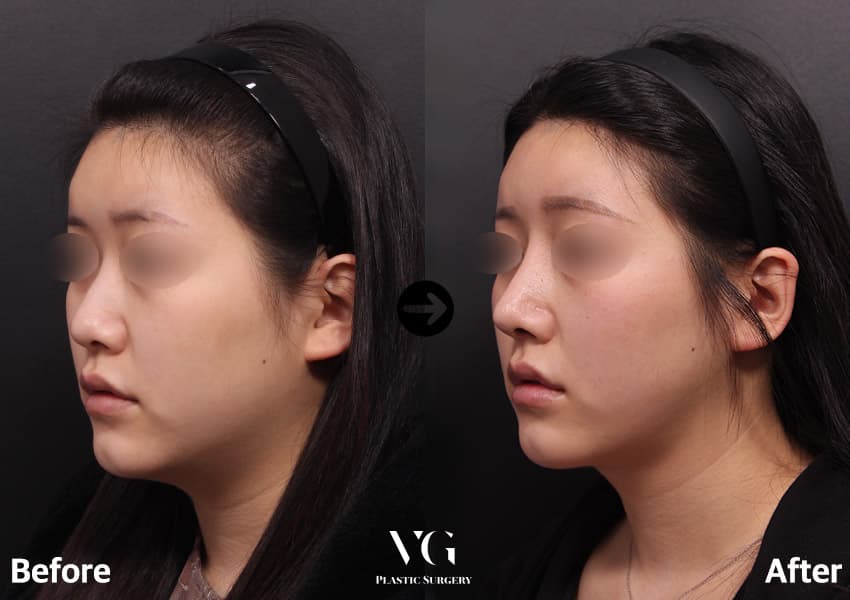 Rhinoplasty + Osteotomy (Bridge Narrowing) + Bulbous Tip Correction +2