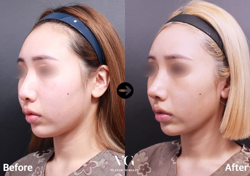 Rhinoplasty + Tip Plasty + Hump Reduction +1
