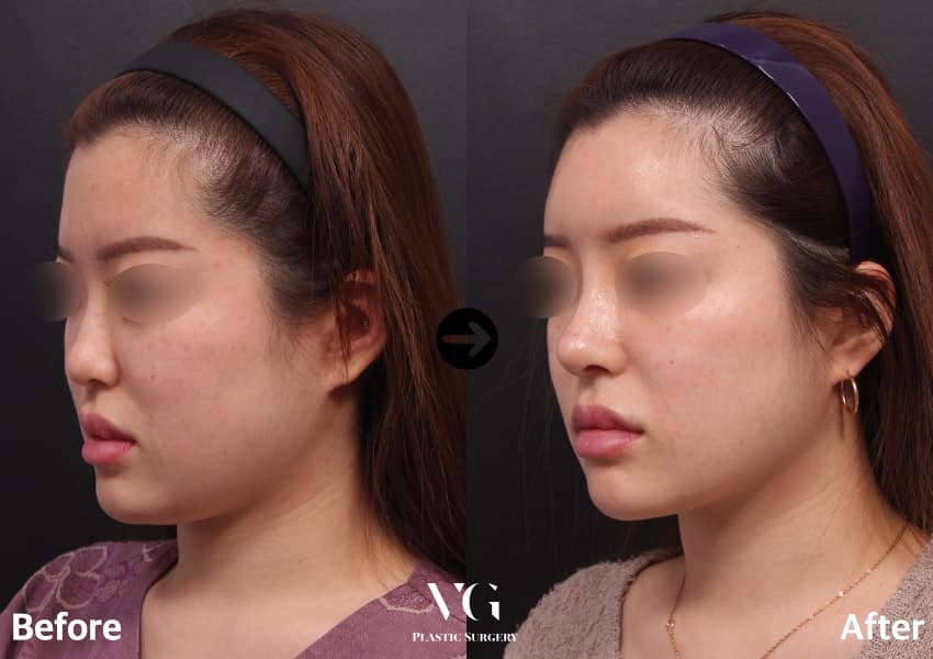 Rhinoplasty + Short Nose Correction + Donor Rib Cartilage