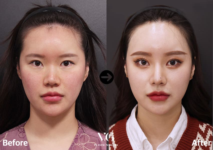 Rhinoplasty + Bulbous Tip Correction + Forehead Lift +1