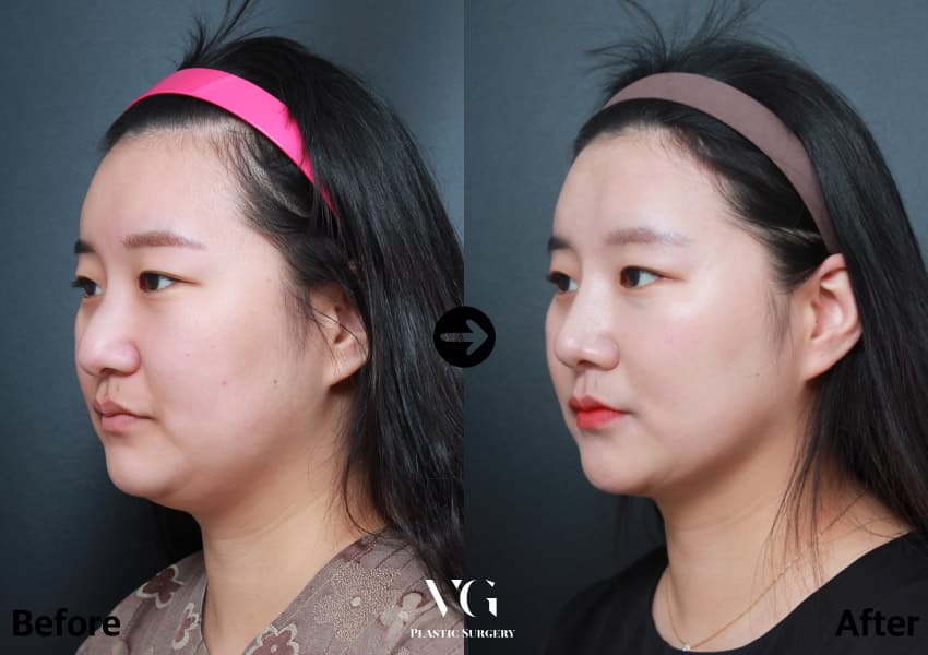 Rhinoplasty + Bulbous Tip Correction + Osteotomy (Bridge Narrowing) +1
