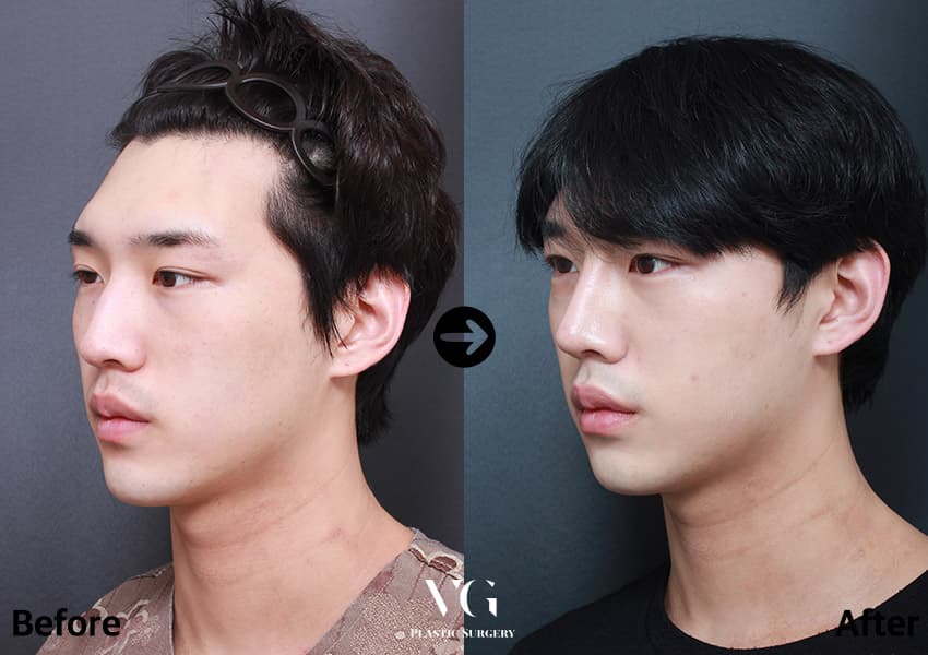 Rhinoplasty + Hump Reduction + Osteotomy (Bridge Narrowing)