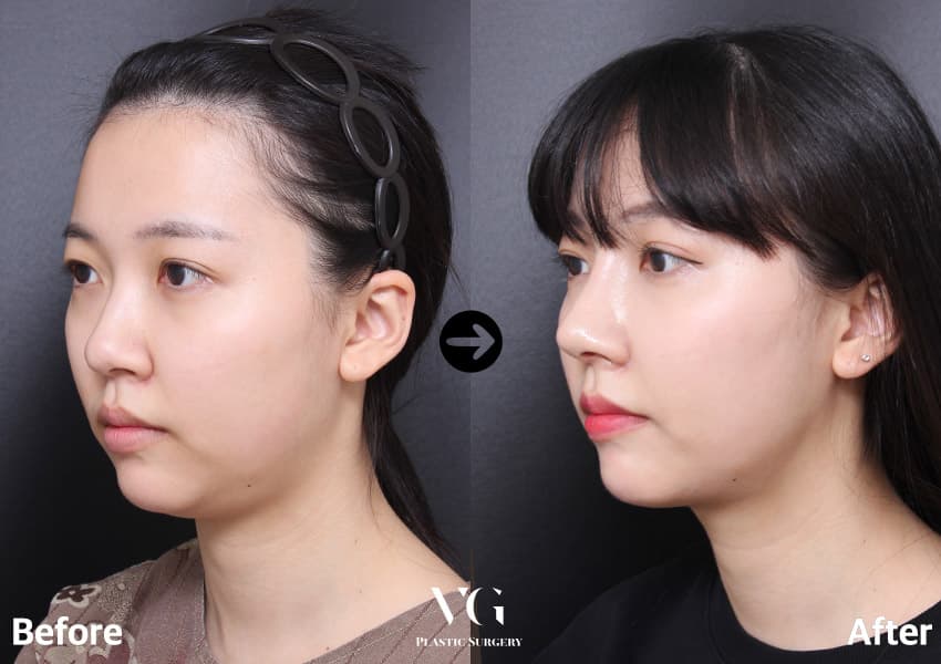 Revision Rhinoplasty + Alar Base Reduction + Double-Chin Liposuction