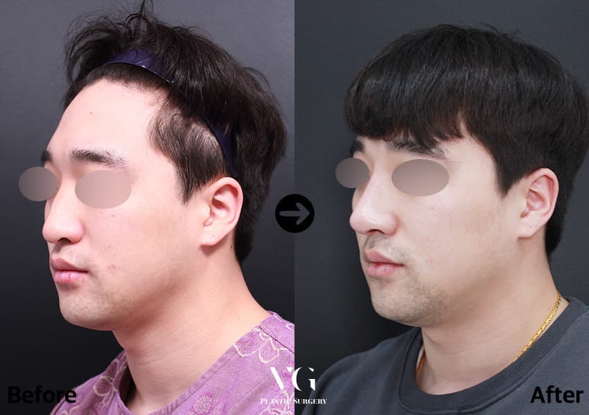 Rhinoplasty + Autologous Rib Cartilage + Deviated Nose Correction +1