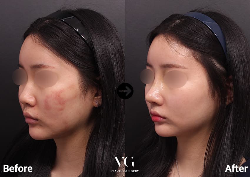 Rhinoplasty + Donor Rib Cartilage