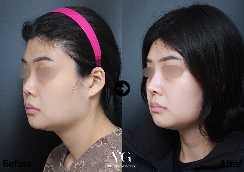 Rhinoplasty + Short Nose Correction