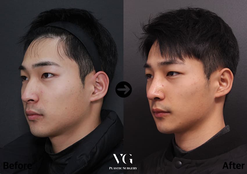 Rhinoplasty + Hump Reduction + Osteotomy (Bridge Narrowing) +1