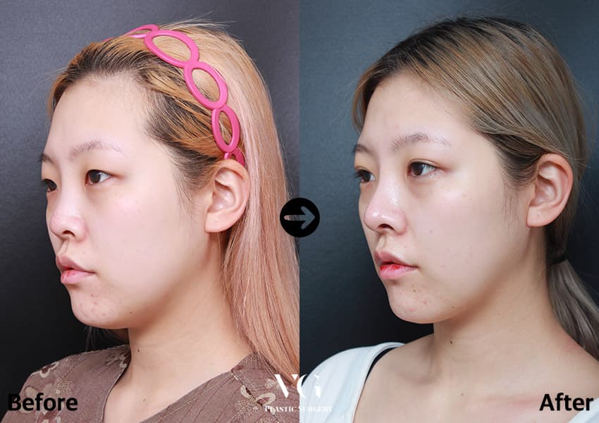 Rhinoplasty + Alar Base Reduction + Autologous Rib Cartilage +2