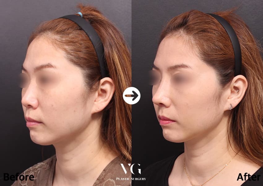 Rhinoplasty + Osteotomy (Bridge Narrowing) + Donor Rib Cartilage