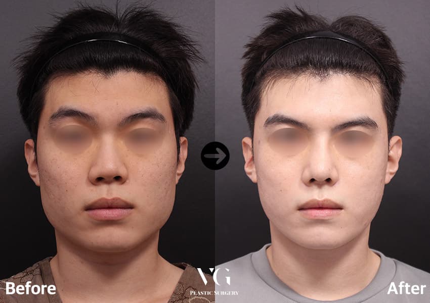 Cheekbone (Zygoma) Reduction + Square Jaw Reduction + Long-Curve Jaw Reduction +4