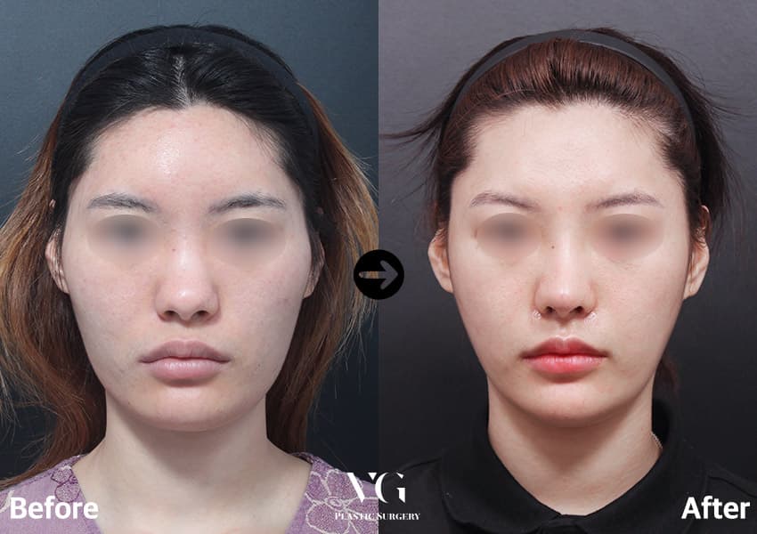 Rhinoplasty + Tip Plasty + Osteotomy (Bridge Narrowing) +3