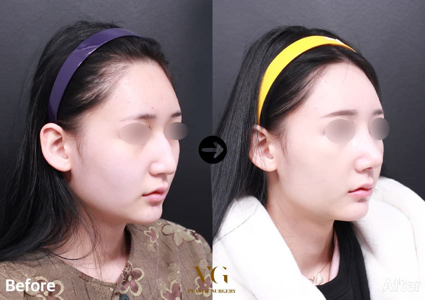 Dorsal Augmentation + Osteotomy (Bridge Narrowing) + Hump Reduction