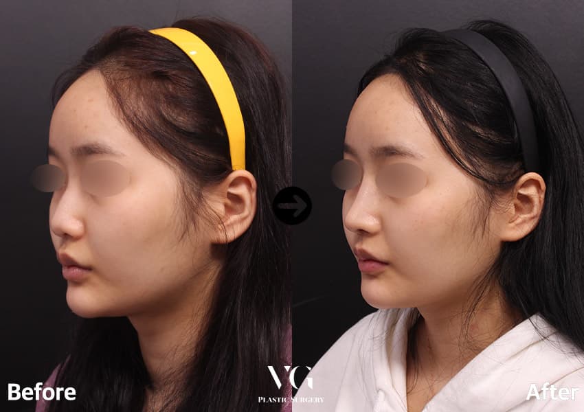 Dorsal Augmentation