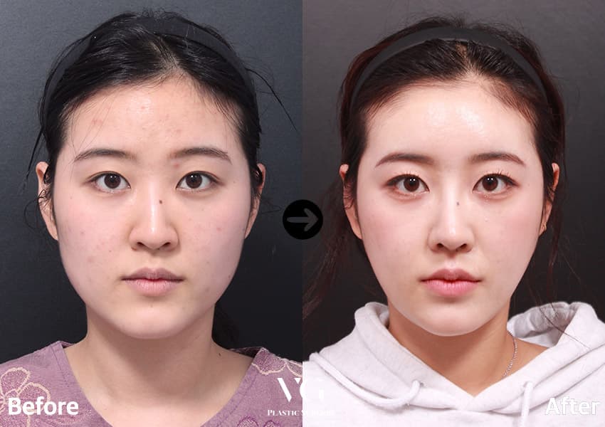 Dorsal Augmentation + Hump Reduction + Cheekbone (Zygoma) Reduction +2