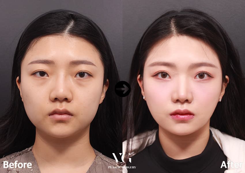 Eye Revision Surgery + Epicanthoplasty (Inner Corner) + Under-Eye Fat Repositioning +4