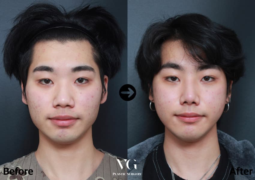 Cheekbone (Zygoma) Reduction + Square Jaw Reduction + Chin Advancement +4