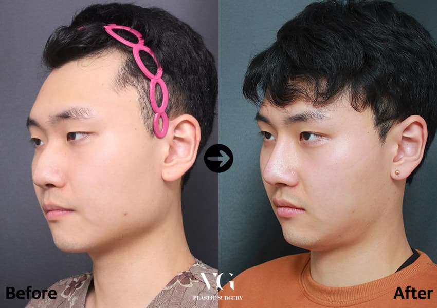 Natural-Adhesion Double Eyelid + Non-Incisional Ptosis Correction + Rhinoplasty +1