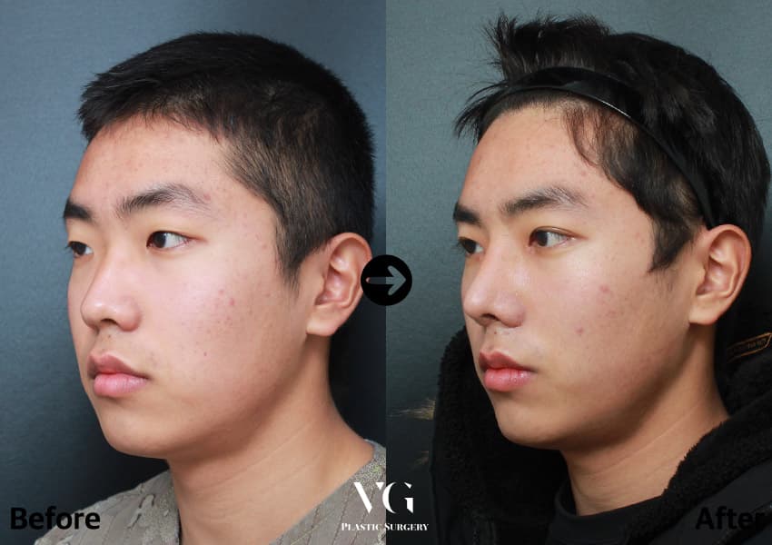 Nose before and after — drag to compare