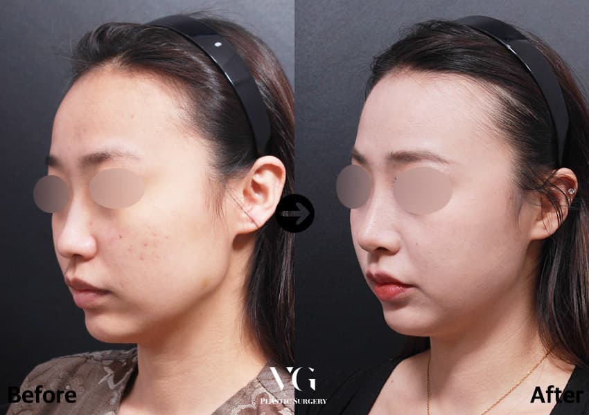 Nose before and after — drag to compare