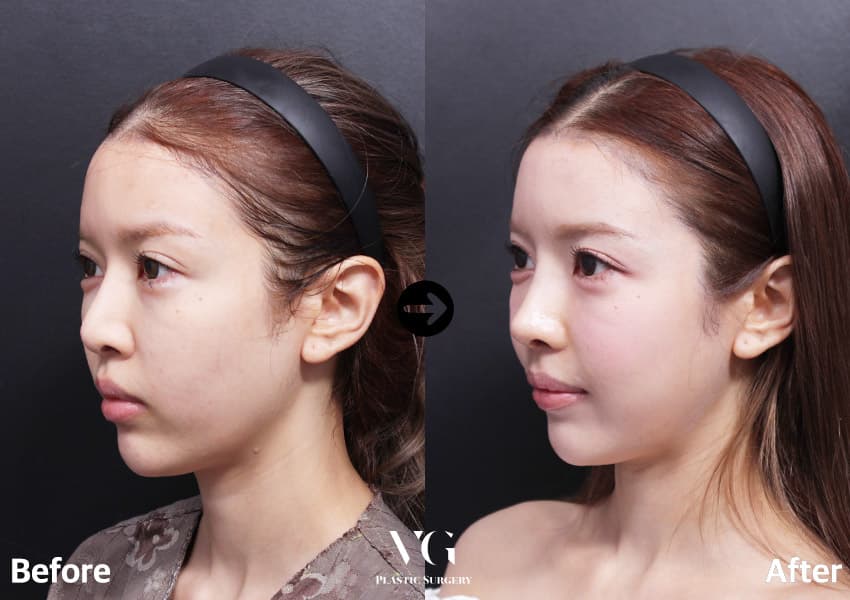 Nose before and after — drag to compare