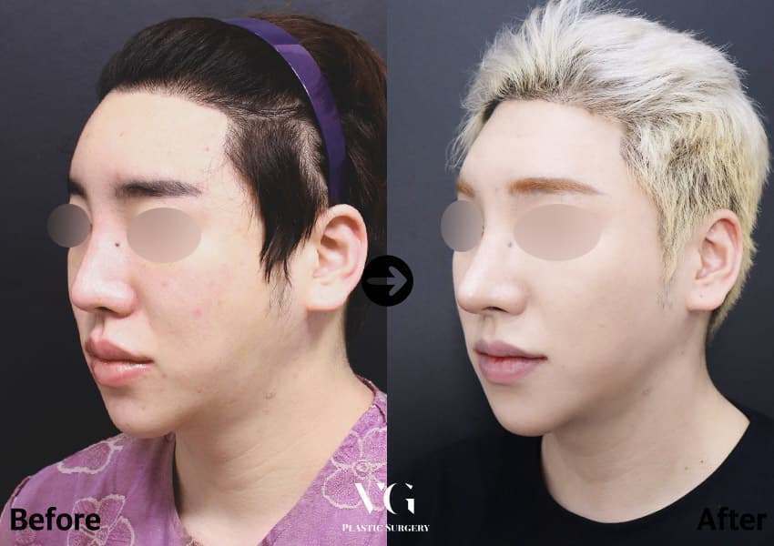 Nose before and after — drag to compare