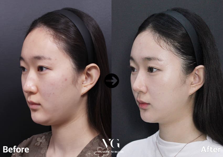 Nose before and after — drag to compare