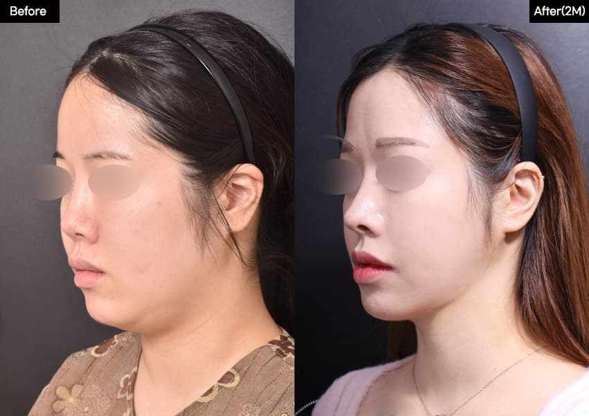 Nose before and after — drag to compare