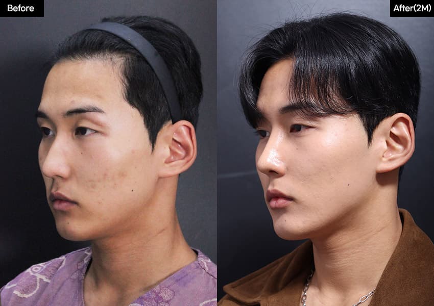 Nose before and after — drag to compare