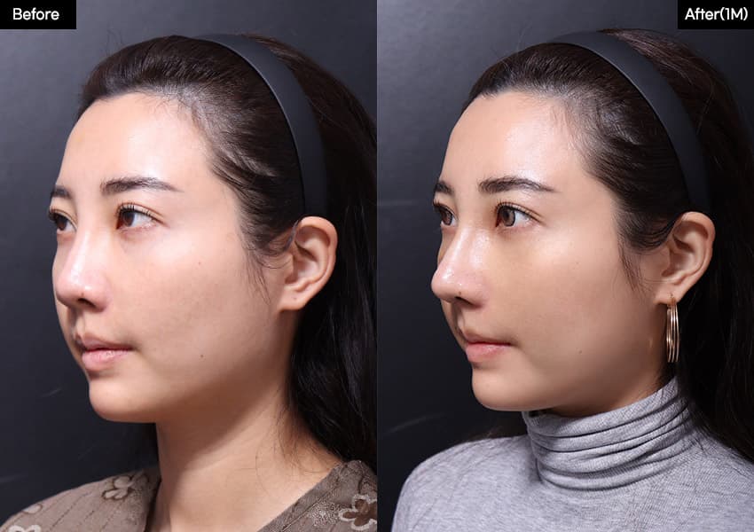 Nose before and after — drag to compare