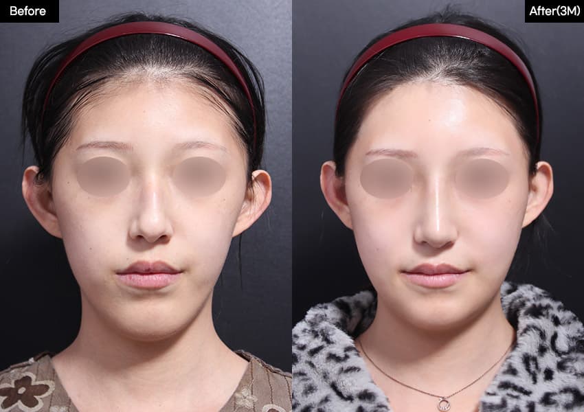 Nose before and after — drag to compare